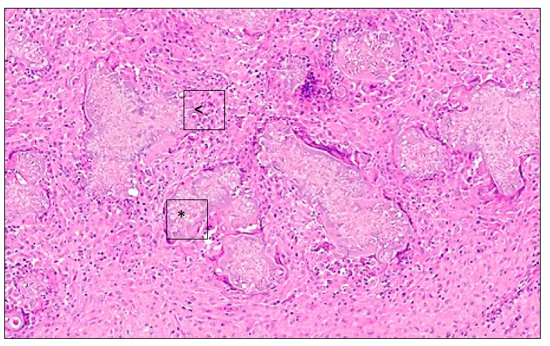 Figure 2. Skin from a 12-year-old cat. Multinucleated giant cells, macrophages and degenerate neutrophils are centered on Splendore Hoeppli material (<) surrounding fungal elements (*). 20x. H&E stain.