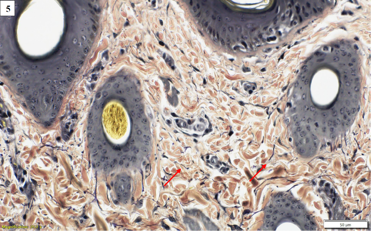 Figures 4 and 5. Affected skin (top) and control skin (bottom), Verhoeff elastin stain, 40X magnification. Elastin fibres (red arrows) are increased in number, thickened, and truncated compared to control. 