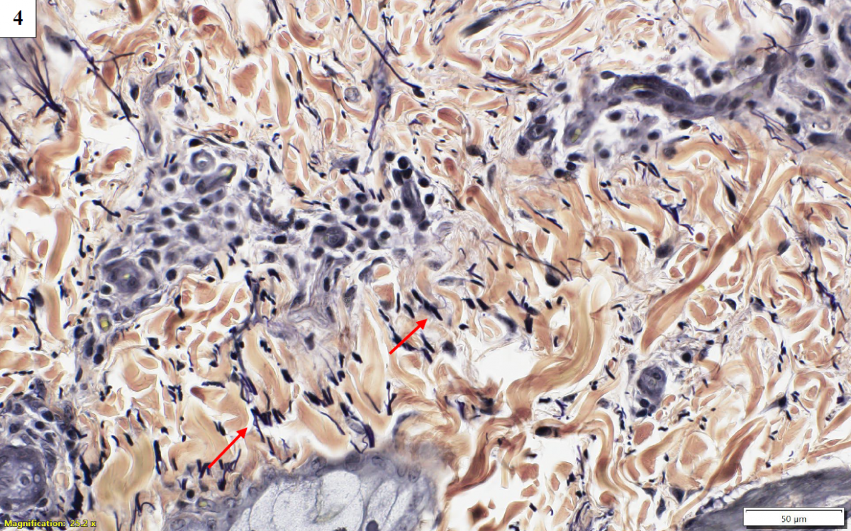 Figures 4 and 5. Affected skin (top) and control skin (bottom), Verhoeff elastin stain, 40X magnification. Elastin fibres (red arrows) are increased in number, thickened, and truncated compared to control. 
