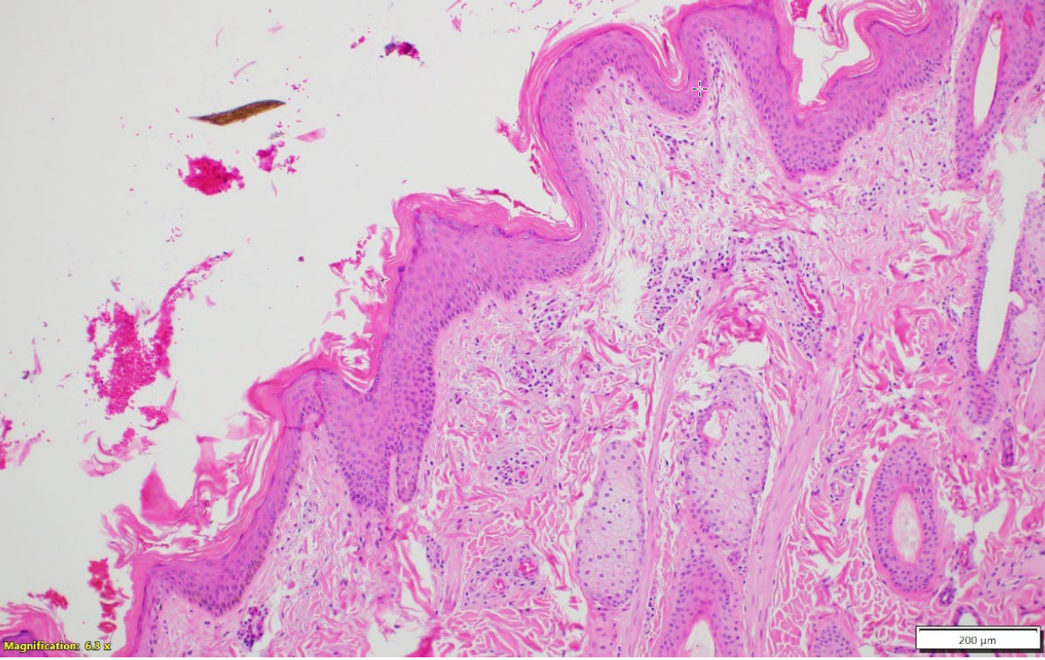 Figure 2. Affected skin, Hematoxylin and Eosin stain, 10X. The epidermis is mildly hyperplastic, hyperkeratotic and has a thickened basement membrane.  There is increased dermal ground substance and thin superficial dermal collagen bundles. 