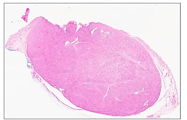 Figure 1. Skin from a 12-year-old cat; there is a focal mass of inflammatory cells elevating the partially ulcerated skin surface (2x). H&E stain.