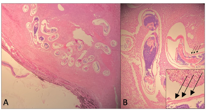 Figure 2. Sclera; H&E stain. 2A. 4X. Within the scleral inflammation there are numerous cross, longitudinal, and tangential sections of nematodes which range from 200 µm – 250 µm in diameter. Many of the parasites are hypereosinophilic. 2B. 10X. The parasites have a ~5-10 µm thick, smooth, eosinophilic cuticle with ring-like circumferential cuticular ridges (annulations) that are apparent in the tangential and longitudinal sections (inset, arrows). The organisms have a pseudocoelom and there are remnants of coelomyarian musculature which is segmentally thinned. The intestine is often eccentrically placed and small, and the reproductive organs contain abundant basophilic granular material.