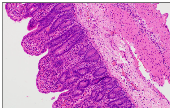 Figure 1. Small intestine from a newly weaned pig presenting with acute watery diarrhea, and atrophic enteritis demonstrated histologically by marked villous atrophy with blunting and fusion. PCR testing of feces was positive for rotavirus A (Ct 11.2), rotavirus B (Ct 27.6), rotavirus C (Ct 28) and porcine sapovirus (Ct 20.4), and negative for porcine coronaviruses. H&E stain.