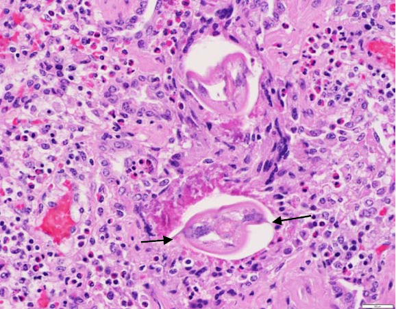 Figure 1. Lung section showing eosinophilic inflammation and cross section of parasites. Note lateral alae (arrows).