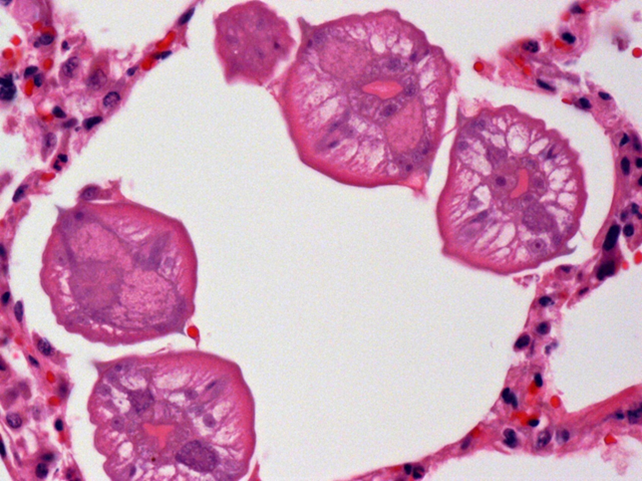 Several ascarid larvae in cross-section within a pulmonary alveolus.