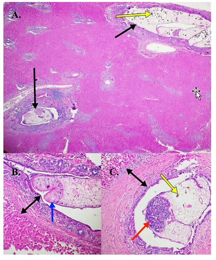 Figure 2. Histologic lesions induced in the liver by infection with the lancet liver fluke in a 3-year-old-ewe. H&E stain. A. Moderate periportal fibrosis and extensive biliary hyperplasia with adult flukes in bile ducts (black arrows). Dark brown pigmented eggs within the adult fluke present grossly as black discolouration in portal triads (yellow arrow). 10x. B.  Bile duct surrounded by biliary hyperplasia and fibrosis (double-headed arrow) containing an adult fluke with a prominent sucker (blue arrow) in the bile duct lumen. 20x. C.  Bile duct surrounded by biliary hyperplasia and fibrosis (double-headed arrow) with an adult fluke with testis and sperm (red arrow) and dark brown pigmented operculated eggs (yellow arrow). 20x. 