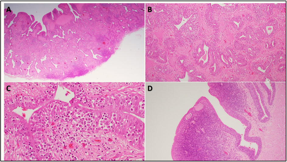Figure 1. Lung and oropharynx in an adult Burmese python (Python bivittatus) with nidovirus-associated proliferative disease (NPD). 