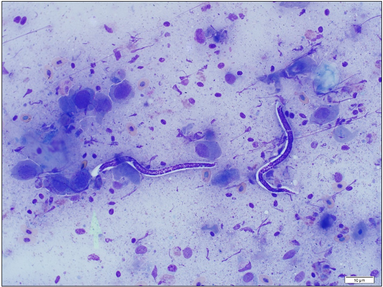 Figure 1. Microfilaria on a background of individual epithelial cells aspirated from a hyperkeratotic lesion on the commissure of the mouth. Wright’s stain. (Image courtesy of Dr. Felipe Reggeti.)