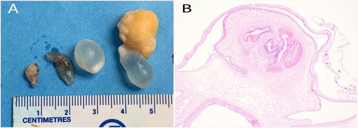 A Free-floating cysts identified in the abdomen (right). The tissue on the left is a biopsy of the urinary bladder. B. Encysted tapeworm larva with prominent hooks (H&E 2X magnification).