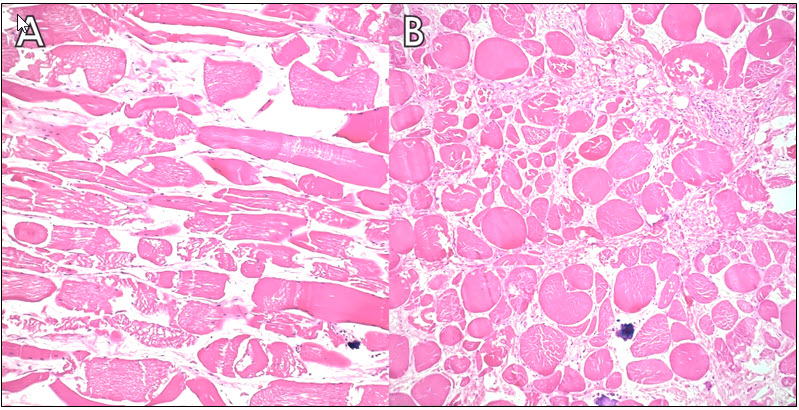 Figure 2. Feline muscular dystrophy skeletal muscle histologic lesions. A. Massive hind limb myocyte necrosis characterized by sarcoplasmic vacuolation, fragmentation, hypereosinophilia and nuclear pyknosis. H&E stain. B. Marked variation of myofiber diameter with alternating atrophied and hypertrophied fibers, regional endomysial and perimysial fibrosis, and foci of mineralization. H&E stain.
