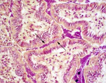 Figure 1. The small intestine villi are coated by a thick layer of Gram-negative bacilli (arrows).