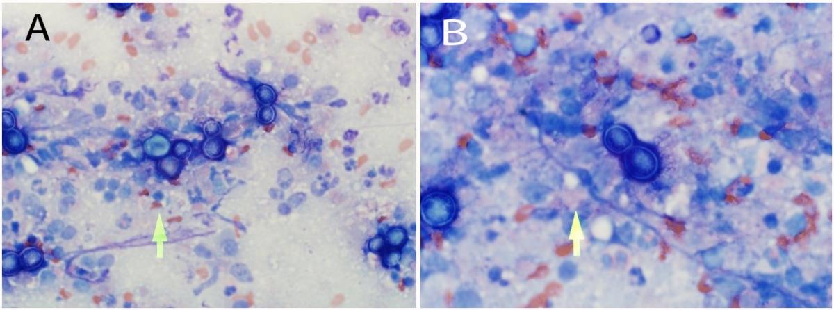 A Blastomyces dermatitidis yeast in a fine aspirate of a lymph node (arrow) (modified Wright’s).	B Broad-based budding of Blastomyces dermatitidis yeast (arrow) (modified Wright’s).