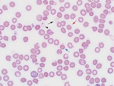 Figure 1. Blood smear with numerous eccentrocytes (red arrow), sometimes with associated Heinz bodies (blue arrow) and ghost cells (black arrow).  The latter also occasionally contained Heinz bodies (black arrowhead). Wright’s stain (1000x).