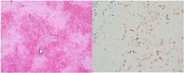 Figure 1. Widespread hepatocellular necrosis with hemorrhage (left, H&E stain); abnormal copper accumulation demonstrated by granular red pigment (right, rhodanine stain). 