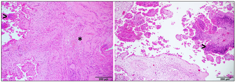 Figure 1. Microscopic section of placenta (10x) containing neutrophilic inflammation accompanied by necrosis (>) and accumulation of fibrin (*). H&E stain.