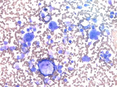 Figure 1. Aspirate of mediastinal mass showing a population of large neoplastic histiocytes with prominent criteria of malignancy, including numerous multinucleated cells. Wright’s stain (600x).