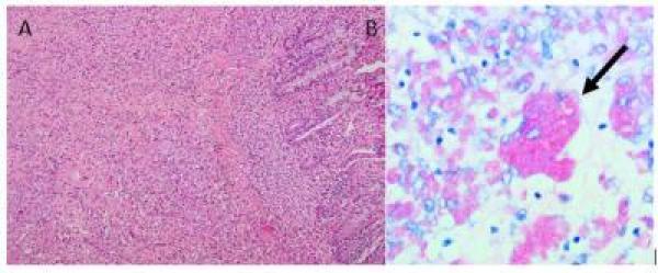 Figure 2. Transmural granulomatous inflammation in the colon associated with Mycobacterium avium subspecies hominissuis. 2A. Histologic section of colon illustrating numerous infiltrating macrophages effacing mucosal and muscularis layers. H&E stain. 2B. Multinucleated giant cell with acid-fast intracytoplasmic bacteria (arrow). Ziehl Neelsen stain.