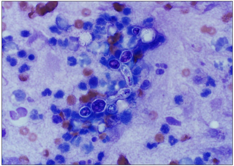 Figure 1. Synovial fluid with yeast and pseudohyphae against an inflammatory cell background.  Wright’s stain.