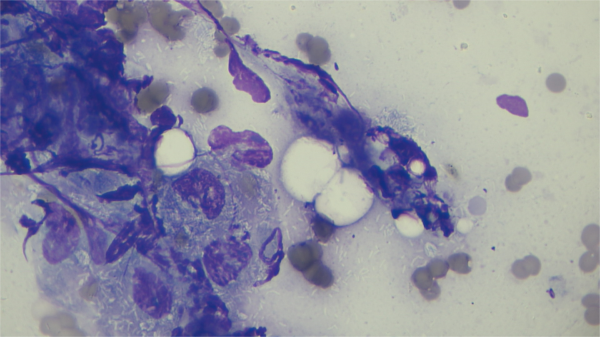 Figure 1. Cytology of foamy macrophages with negatively-staining, intracytoplasmic rod-shaped bacteria (consistent with mycobacteria spp.). Wright’s stain (1000x).