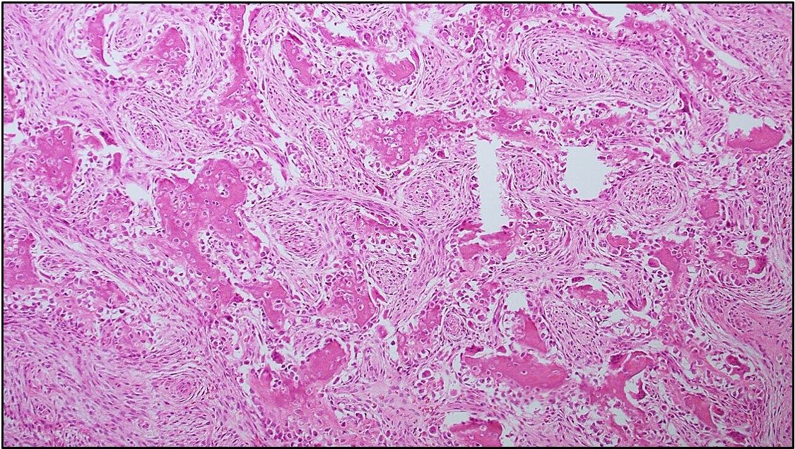Figure 3. Histological features of the excised mass illustrating plump spindle-shaped  cells arranged in interlacing streams, bundles and whorls with foci of eosinophilic  matrix (osteoid). H&E stain. 