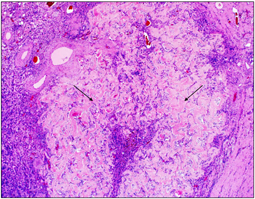 Figure 1. Expanding the duodenal wall are anastomosing trabeculae of deeply eosinophilic collagen (arrows).  H&E.