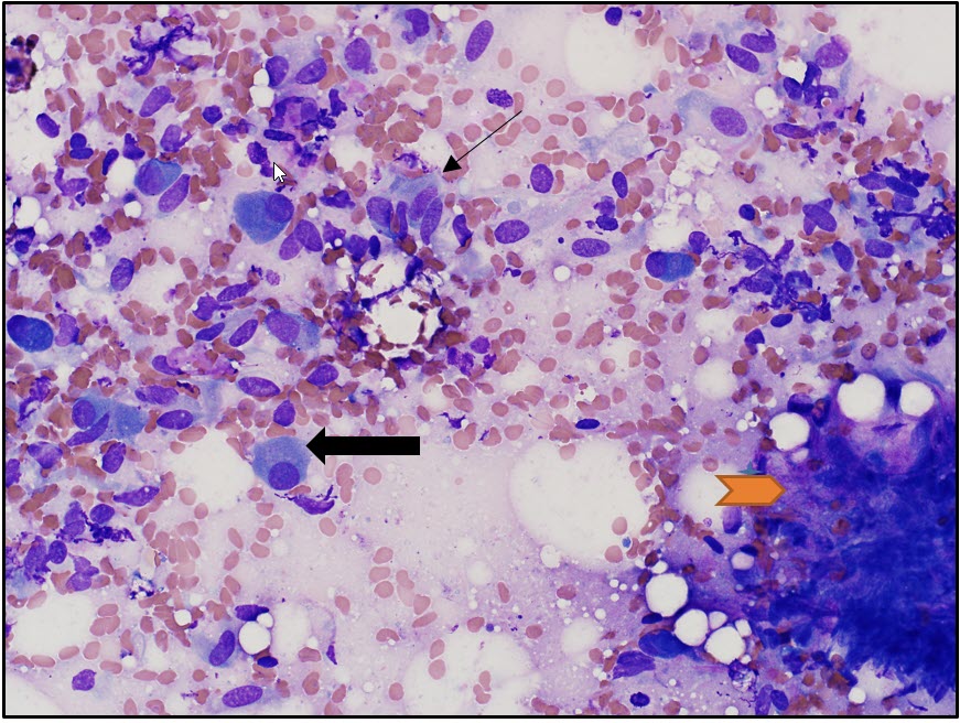 Figure 1. Cytological features of the subcutaneous mass including stromal cells  (slender arrow), osteoblasts (thick arrow), and stromal cells embedded in osteoid  (yellow arrow).  Wright’s stain.