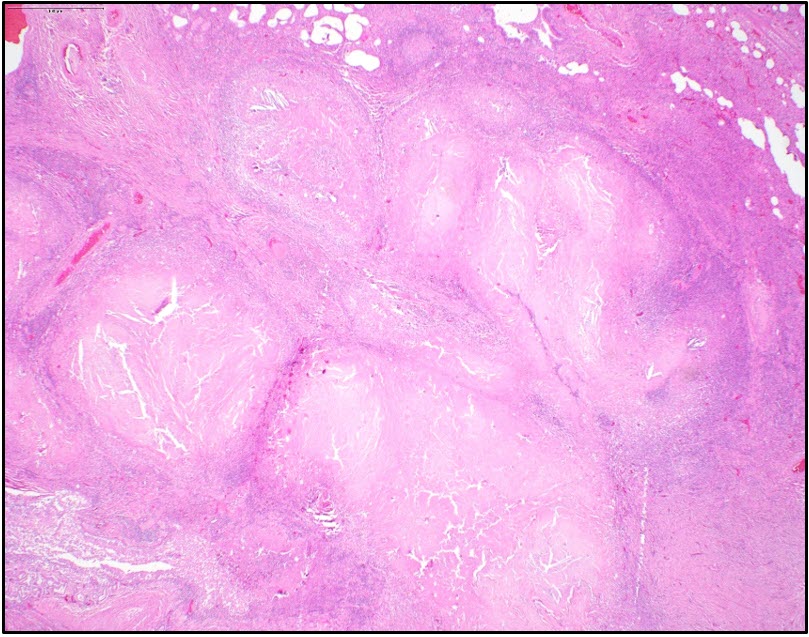 Figure 1. Pulmonary endarteritis, periarterial granulomatous  inflammation secondary to infection with heartworm.  H&E stain
