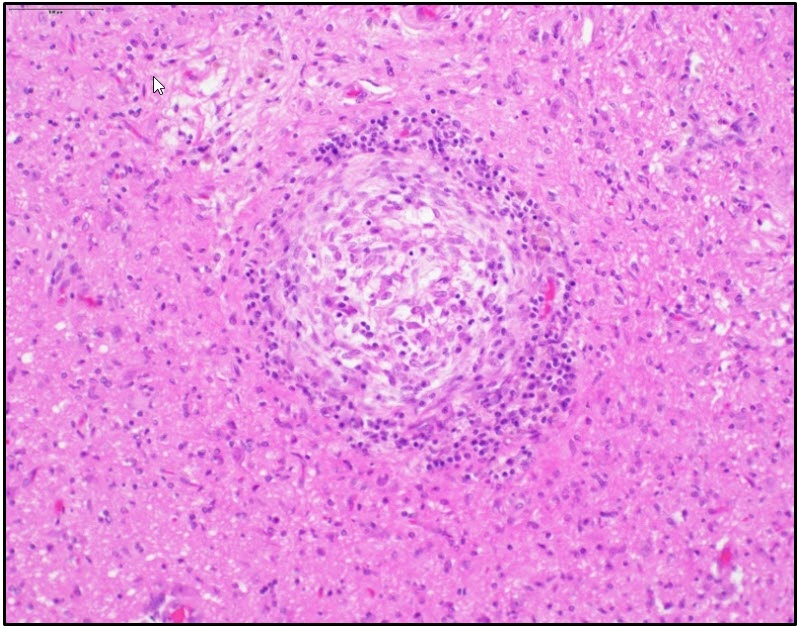 Figure 2. Focal granuloma in the midbrain attributed to aberrant  parasite migration.  H&E stain.