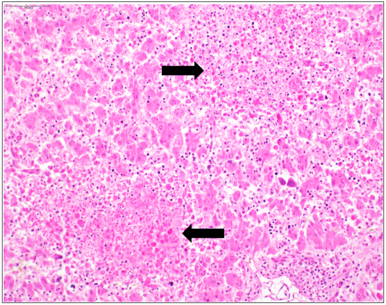 Figure 1.  Bovine fetus, liver.  Two foci of hepatic necrosis (arrows) with loss of hepatocytes, loss of differential staining, and accumulated cell debris.  H&E stain.
