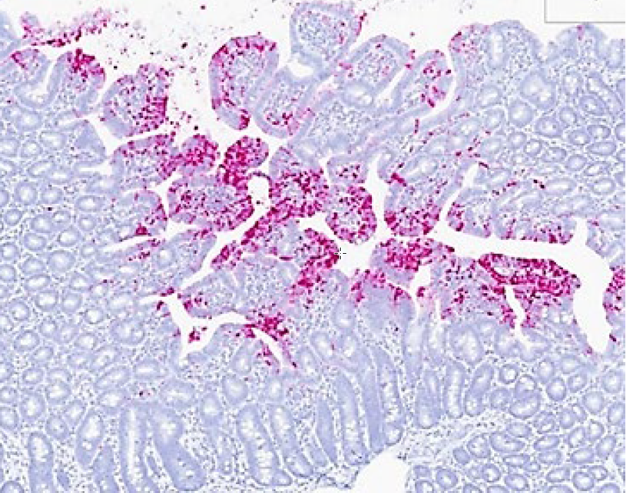 Figure 2.  PSaV RNAscope (in situ hybridization), small intestine of same pig as in Figure 1.  PSaV nuclei acid (pink chromogen) is detected in small intestinal mucosa, predominately in epithelial cells at villus tips and in lamina propria.  Although porcine rotavirus nucleic acid was also detected by PCR in feces from this group, rotavirus antigen was not detected in association with histologic lesions of atrophic enteritis.  Taken together, these results support PSaV as the primary etiology for atrophic enteritis and diarrhea in this group.  Photo courtesy of Dr. R. Derscheid, Iowa State University. 