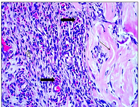 Figure 2. Reactive fibroblasts and eosinophils (thick arrows) surround the collagen trabeculae (thin arrow).  H&E.