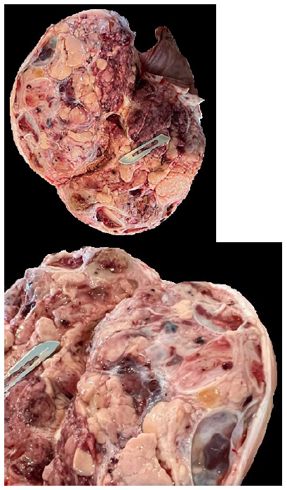 Figures 3 and 4. Bisected testis. On cut section, the mass is both multinodular and cystic, with thick bands of fibrous connective tissue. There is no recognizable testicular tissue present. 