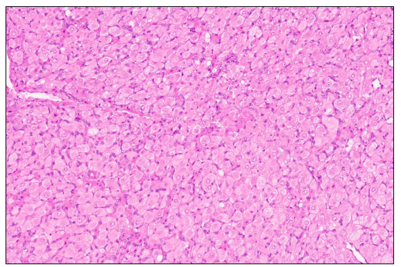 Figure 5. Testicular mass, 10X Hematoxylin & Eosin. 
