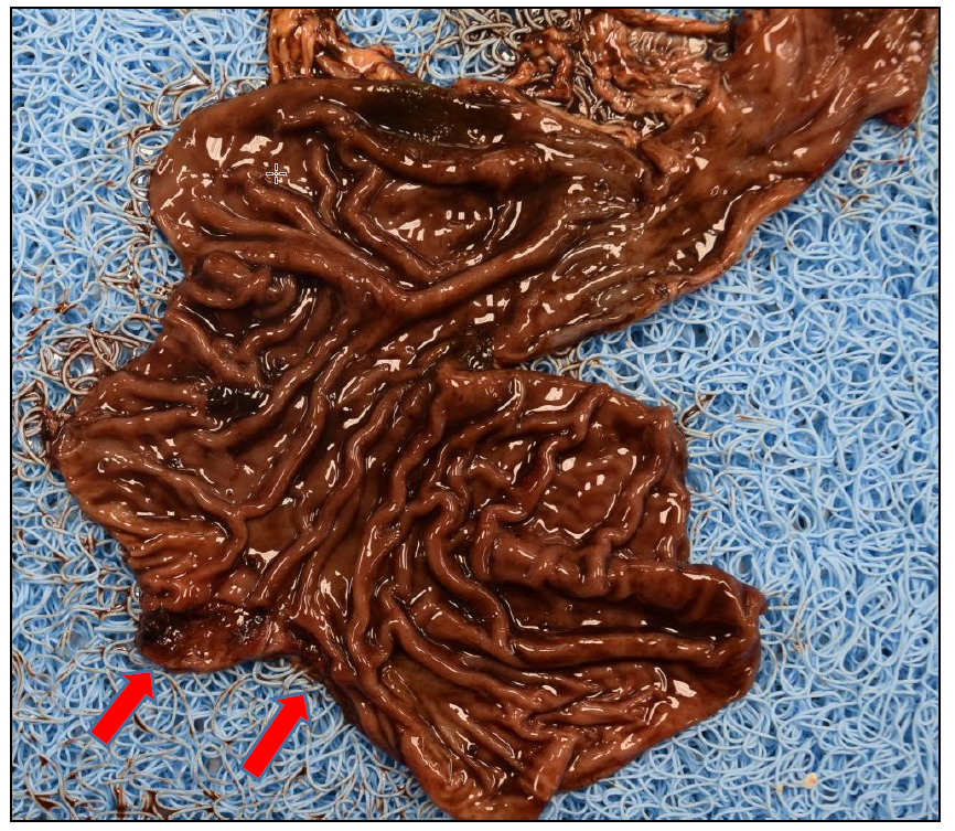 Figure 1. Linear tear in the gastric mucosa (arrows).