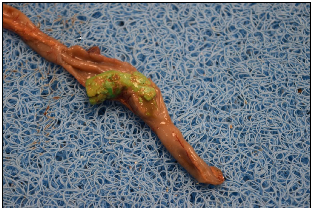 Figure 2. Obstructive foreign body (green foam) in the lumen of the distal small intestine