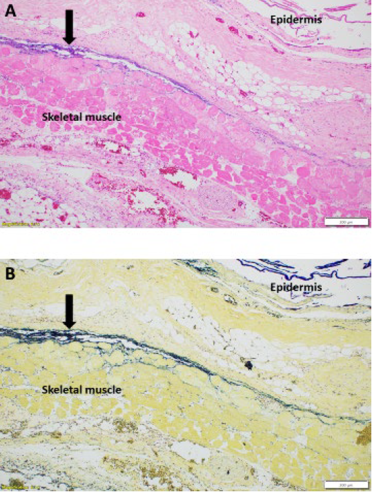  Gram stain showing blue staining of Gram-positive rod bacteria consistent with clostridial species (arrow). 