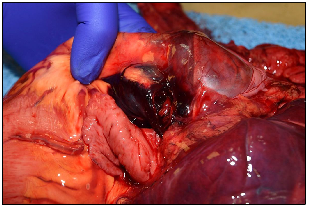 Figure 1.  Pulmonary artery rupture, serosal surface.