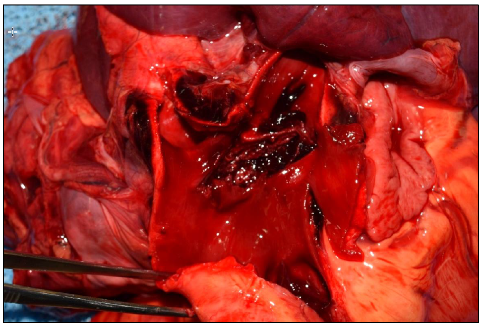 Figure 2. Pulmonary artery rupture, intimal surface