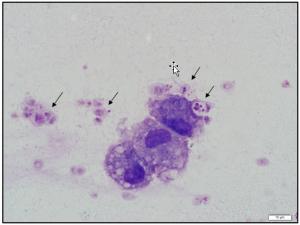 Figure 1. Three macrophages and associated, variably intact P.jirovecci cysts containing intra-cystic bodies (arrows). Wright’s stain.  Image credit Dr. Janet Beeler-Marfisi.