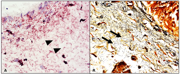 Figure 2.  Leptospiral placentitis in a Hanoverian foal.  Chorioallantois with immunohistochemistry for Leptospira (A) and Warthin-Starry silver stain (B).  There is both positive red immunostaining (arrowheads) and silver staining (arrows) of innumerable individual leptospires in the edematous chorioallantois.