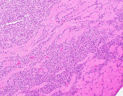 Figure 1. Suppurative to pyogranulomatous inflammation in the skeletal muscle. H&E stain.