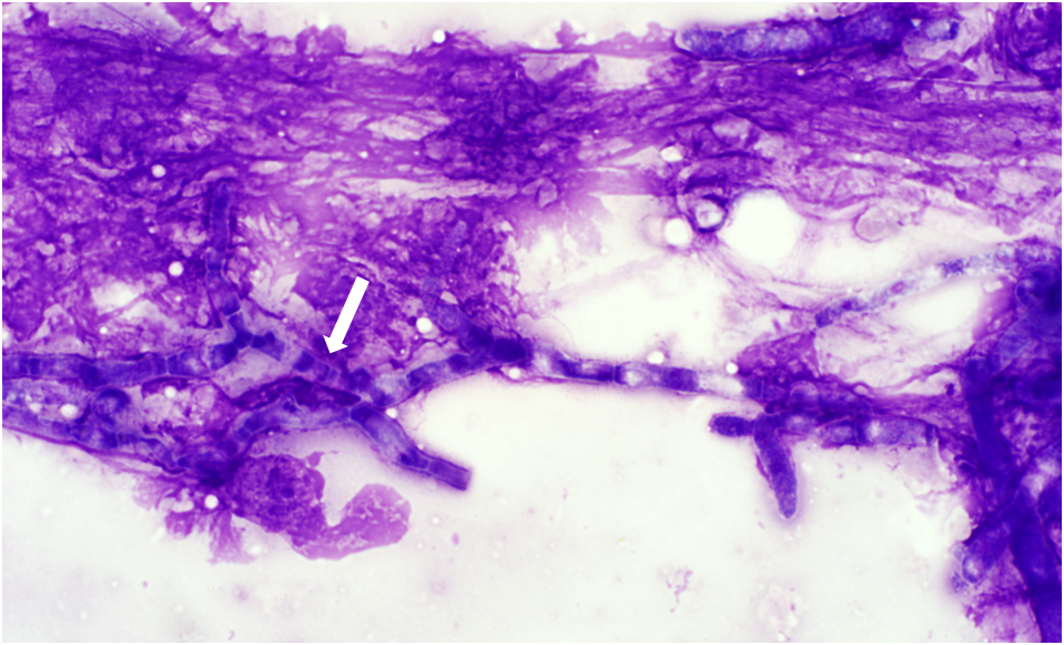 Figure 1.  A cluster of septate, branching fungal hyphae (an arrow) embedded within lytic cellular debris. (Wright’s stain)  Image courtesy of Katherine Morrison.    