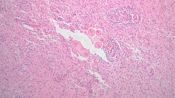 Figure 1. Brain (thalamus) with perivascular cuffing and scattered foci of malacia and gliosis with five adjacent embedded cross and tangential sections of nematode larvae consistent with neural larval migrans of an ascarid nematode. H&E stain.