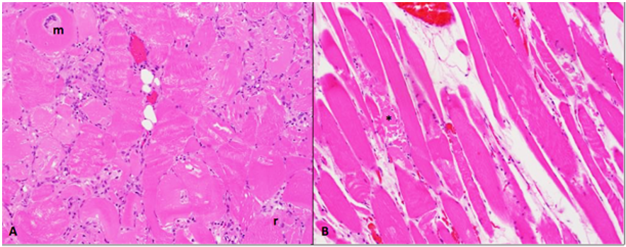 Figure 1. Polyphasic epaxial and postural muscle degeneration and necrosis in two Kunekune sows.   A, B.  Hypereosinophilia and fragmentation of myofibres (*), infiltration of macrophages (m), and early regeneration (r). 20x. H&E stain.