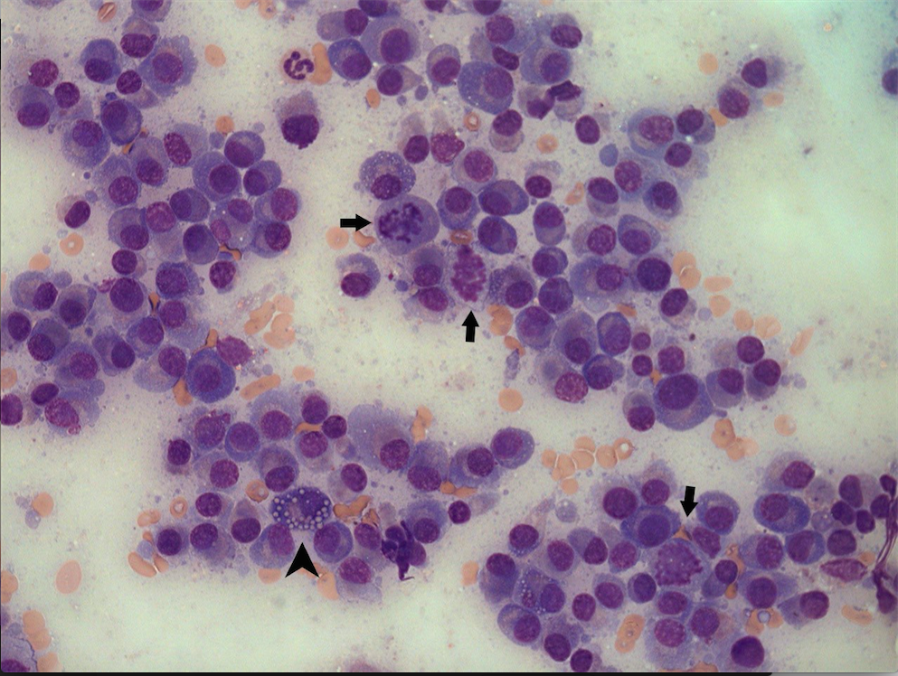 Figure 1. Gastric mass aspirate showing a monotypic population of neoplastic plasma cells with increased mitotic activity (arrows) and intracytoplasmic Russell bodies (arrowhead). Wright’s (400X) 