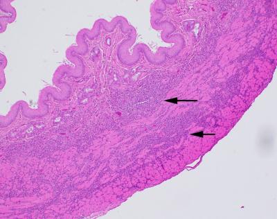 Figure 2. Inflammation involving the muscular wall of the esophagus (black arrows). H&E stain.