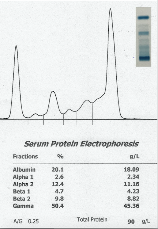 Figure 2. Serum protein electrophoresis. The discrete band at the bottom of the cellulose acetate strip (upper right) is represented by a narrow-based peak in the gamma globulin region of the densitogram, consistent with a monoclonal gammopathy. 