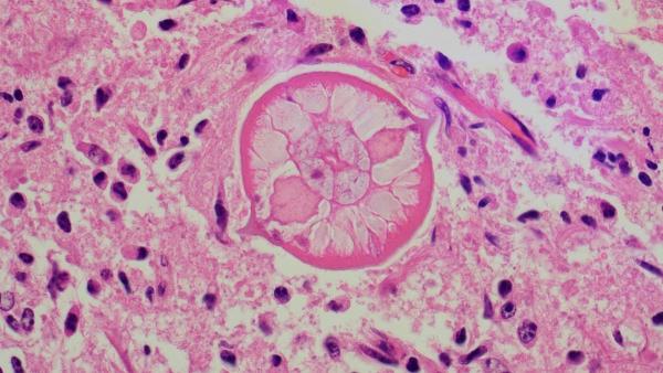   Figure 2. Larvae are ~ 30 to 50 µm wide with a 3-5 µm thick cuticle, prominent lateral chords and characteristic lateral alae, coelomyarian-polymyarian musculature, pseudocoelom, and an intestine lined by uninucleate columnar epithelial cells.  Eosinophils are present within the adjacent neuropil. H&E stain.