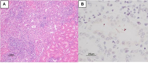 Figure 2. Histologic sections of renal leptospirosis.  Kidney with tubulointerstitial nephritis (A).   H&E stain.  Immunostaining highlights filamentous leptospires within a tubular lumen (B).  IHC 
