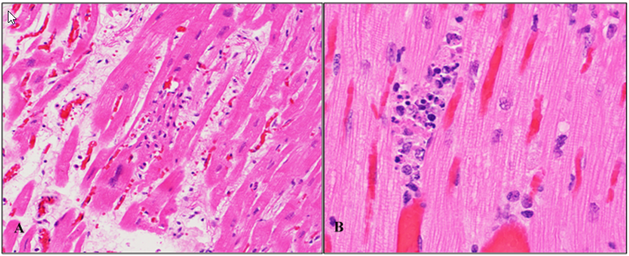 Figure 2. Myonecrosis in the hearts of two Kunekune sows. A-20x, B-60x. H&E stain.